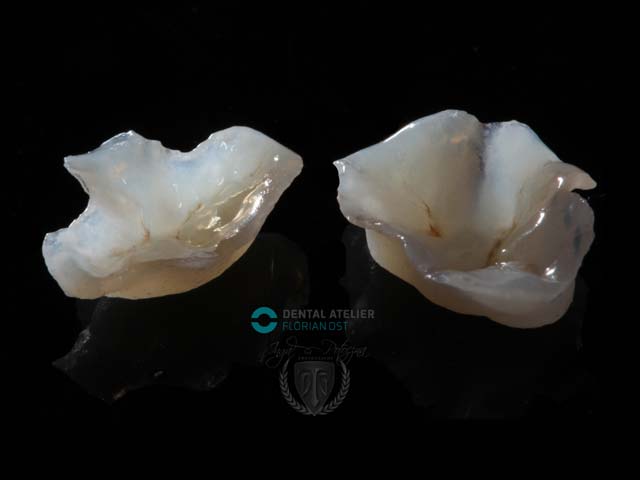 Keramik-/Implantatrestaurationen Keramik-/Implantatrestaurationen
